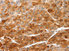 The image on the left is immunohistochemistry of paraffin-embedded Human liver cancer tissue using CSB-PA244699 (CIDEC Antibody) at dilution 1/50, on the right is treated with fusion protein. (Original magnification: ×200)