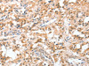 The image on the left is immunohistochemistry of paraffin-embedded Human thyroid cancer tissue using CSB-PA244699 (CIDEC Antibody) at dilution 1/50, on the right is treated with fusion protein. (Original magnification: ×200)