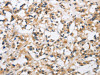 The image is immunohistochemistry of paraffin-embedded Human thyroid cancer tissue using CSB-PA698913 (CKMT2 Antibody) at dilution 1/60. (Original magnification: ×200)