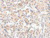 The image on the left is immunohistochemistry of paraffin-embedded Human thyroid cancer tissue using CSB-PA939596 (CLIP1 Antibody) at dilution 1/30, on the right is treated with fusion protein. (Original magnification: ×200)