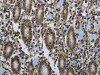 The image on the left is immunohistochemistry of paraffin-embedded Human gastric cancer tissue using CSB-PA591518 (CLPS Antibody) at dilution 1/40, on the right is treated with fusion protein. (Original magnification: ×200)