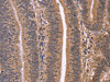 The image on the left is immunohistochemistry of paraffin-embedded Human colon cancer tissue using CSB-PA911084 (CLUAP1 Antibody) at dilution 1/50, on the right is treated with fusion protein. (Original magnification: ×200) The image on the left is immunohistochemistry of paraffin-embedded Human colon cancer tissue using CSB-PA911084 (CLUAP1 Antibody) at dilution 1/50, on the right is treated with fusion protein. (Original magnification: ×200)