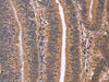 The image on the left is immunohistochemistry of paraffin-embedded Human colon cancer tissue using CSB-PA911084 (CLUAP1 Antibody) at dilution 1/50, on the right is treated with fusion protein. (Original magnification: ×200)