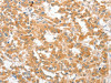 The image on the left is immunohistochemistry of paraffin-embedded Human thyroid cancer tissue using CSB-PA785654 (COL4A3BP Antibody) at dilution 1/60, on the right is treated with fusion protein. (Original magnification: ×200)