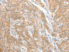 The image on the left is immunohistochemistry of paraffin-embedded Human gastric cancer tissue using CSB-PA785654 (COL4A3BP Antibody) at dilution 1/60, on the right is treated with fusion protein. (Original magnification: ×200)