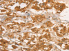 The image on the left is immunohistochemistry of paraffin-embedded Human thyroid cancer tissue using CSB-PA043712 (CPB1 Antibody) at dilution 1/50, on the right is treated with fusion protein. (Original magnification: ×200)