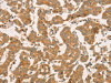 The image on the left is immunohistochemistry of paraffin-embedded Human breast cancer tissue using CSB-PA043712 (CPB1 Antibody) at dilution 1/50, on the right is treated with fusion protein. (Original magnification: ×200)