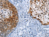 The image on the left is immunohistochemistry of paraffin-embedded Human cervical cancer tissue using CSB-PA121899 (CRABP2 Antibody) at dilution 1/40, on the right is treated with fusion protein. (Original magnification: ×200)