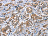 The image on the left is immunohistochemistry of paraffin-embedded Human breast cancer tissue using CSB-PA168224 (CRABP2 Antibody) at dilution 1/20, on the right is treated with fusion protein. (Original magnification: ×200)