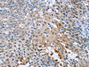 The image on the left is immunohistochemistry of paraffin-embedded Human cervical cancer tissue using CSB-PA168224 (CRABP2 Antibody) at dilution 1/20, on the right is treated with fusion protein. (Original magnification: ×200)