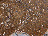 The image on the left is immunohistochemistry of paraffin-embedded Human cervical cancer tissue using CSB-PA038229 (REL Antibody) at dilution 1/50, on the right is treated with fusion protein. (Original magnification: ×200)