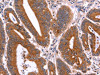 The image on the left is immunohistochemistry of paraffin-embedded Human colon cancer tissue using CSB-PA951162 (CRISP3 Antibody) at dilution 1/40, on the right is treated with fusion protein. (Original magnification: ×200)