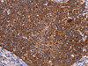 The image on the left is immunohistochemistry of paraffin-embedded Human cervical cancer tissue using CSB-PA967648 (CROT Antibody) at dilution 1/50, on the right is treated with fusion protein. (Original magnification: ×200)