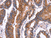 The image on the left is immunohistochemistry of paraffin-embedded Human colon cancer tissue using CSB-PA967648 (CROT Antibody) at dilution 1/50, on the right is treated with fusion protein. (Original magnification: ×200)