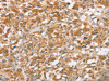 The image on the left is immunohistochemistry of paraffin-embedded Human thyroid cancer tissue using CSB-PA966173 (CTAGE5 Antibody) at dilution 1/40, on the right is treated with fusion protein. (Original magnification: ×200)