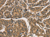 The image on the left is immunohistochemistry of paraffin-embedded Human breast cancer tissue using CSB-PA216273 (CTNNBIP1 Antibody) at dilution 1/30, on the right is treated with fusion protein. (Original magnification: ×200)