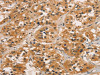 The image on the left is immunohistochemistry of paraffin-embedded Human thyroid cancer tissue using CSB-PA216273 (CTNNBIP1 Antibody) at dilution 1/30, on the right is treated with fusion protein. (Original magnification: ×200)