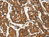 The image on the left is immunohistochemistry of paraffin-embedded Human breast cancer tissue using CSB-PA556194 (CTNNBIP1 Antibody) at dilution 1/20, on the right is treated with fusion protein. (Original magnification: ×200)