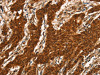 The image on the left is immunohistochemistry of paraffin-embedded Human gastric cancer tissue using CSB-PA556194 (CTNNBIP1 Antibody) at dilution 1/20, on the right is treated with fusion protein. (Original magnification: ×200)