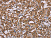 The image on the left is immunohistochemistry of paraffin-embedded Human thyroid cancer tissue using CSB-PA781876 (PPIF Antibody) at dilution 1/45, on the right is treated with fusion protein. (Original magnification: ×200)