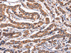 The image on the left is immunohistochemistry of paraffin-embedded Human breast cancer tissue using CSB-PA903914 (PPIF Antibody) at dilution 1/60, on the right is treated with fusion protein. (Original magnification: ×200)