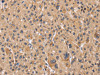 The image on the left is immunohistochemistry of paraffin-embedded Human liver cancer tissue using CSB-PA903914 (PPIF Antibody) at dilution 1/60, on the right is treated with fusion protein. (Original magnification: ×200)