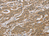 The image on the left is immunohistochemistry of paraffin-embedded Human gastric cancer tissue using CSB-PA122670 (CYFIP2 Antibody) at dilution 1/25, on the right is treated with fusion protein. (Original magnification: ×200)