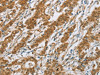 The image on the left is immunohistochemistry of paraffin-embedded Human gastric cancer tissue using CSB-PA216877 (CYP2E1 Antibody) at dilution 1/30, on the right is treated with fusion protein. (Original magnification: ×200)