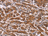 The image on the left is immunohistochemistry of paraffin-embedded Human breast cancer tissue using CSB-PA910505 (CYP2W1 Antibody) at dilution 1/25, on the right is treated with fusion protein. (Original magnification: ×200)
