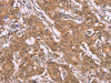 The image on the left is immunohistochemistry of paraffin-embedded Human gastric cancer tissue using CSB-PA910505 (CYP2W1 Antibody) at dilution 1/25, on the right is treated with fusion protein. (Original magnification: ×200)