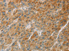 The image on the left is immunohistochemistry of paraffin-embedded Human liver cancer tissue using CSB-PA248001 (CYP11B1 Antibody) at dilution 1/30, on the right is treated with fusion protein. (Original magnification: ×200)