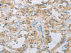 The image on the left is immunohistochemistry of paraffin-embedded Human thyroid cancer tissue using CSB-PA248001 (CYP11B1 Antibody) at dilution 1/30, on the right is treated with fusion protein. (Original magnification: ×200)