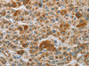 The image on the left is immunohistochemistry of paraffin-embedded Human liver cancer tissue using CSB-PA446866 (CYP27A1 Antibody) at dilution 1/50, on the right is treated with fusion protein. (Original magnification: ×200) The image on the left is immunohistochemistry of paraffin-embedded Human liver cancer tissue using CSB-PA446866 (CYP27A1 Antibody) at dilution 1/50, on the right is treated with fusion protein. (Original magnification: ×200)
