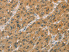 The image on the left is immunohistochemistry of paraffin-embedded Human liver cancer tissue using CSB-PA898841 (CYP11A1 Antibody) at dilution 1/50, on the right is treated with fusion protein. (Original magnification: ×200)