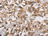 The image on the left is immunohistochemistry of paraffin-embedded Human thyroid cancer tissue using CSB-PA263571 (CYP21A2 Antibody) at dilution 1/60, on the right is treated with fusion protein. (Original magnification: ×200)