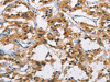 The image on the left is immunohistochemistry of paraffin-embedded Human thyroid cancer tissue using CSB-PA891037 (CYP21A2 Antibody) at dilution 1/60, on the right is treated with fusion protein. (Original magnification: ×200)