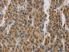 The image is immunohistochemistry of paraffin-embedded Human liver cancer tissue using CSB-PA877526 (LOXL4 Antibody) at dilution 1/20. (Original magnification: ×200)