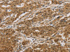 The image on the left is immunohistochemistry of paraffin-embedded Human gastric cancer tissue using CSB-PA084737 (HSPA4 Antibody) at dilution 1/20, on the right is treated with fusion protein. (Original magnification: ×200)