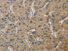 The image on the left is immunohistochemistry of paraffin-embedded Human liver cancer tissue using CSB-PA593332 (TBXAS1 Antibody) at dilution 1/30, on the right is treated with fusion protein. (Original magnification: ×200)
