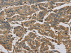 The image on the left is immunohistochemistry of paraffin-embedded Human breast cancer tissue using CSB-PA593332 (TBXAS1 Antibody) at dilution 1/30, on the right is treated with fusion protein. (Original magnification: ×200)
