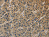 The image on the left is immunohistochemistry of paraffin-embedded Human liver cancer tissue using CSB-PA243064 (TBXAS1 Antibody) at dilution 1/25, on the right is treated with fusion protein. (Original magnification: ×200)