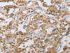 The image on the left is immunohistochemistry of paraffin-embedded Human thyroid cancer tissue using CSB-PA913264 (CYP4A11 Antibody) at dilution 1/25, on the right is treated with fusion protein. (Original magnification: ×200)
