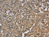 The image on the left is immunohistochemistry of paraffin-embedded Human thyroid cancer tissue using CSB-PA870342 (CYB5A Antibody) at dilution 1/30, on the right is treated with fusion protein. (Original magnification: ×200)
