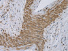 The image on the left is immunohistochemistry of paraffin-embedded Human cervical cancer tissue using CSB-PA870342 (CYB5A Antibody) at dilution 1/30, on the right is treated with fusion protein. (Original magnification: ×200)