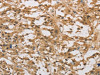 The image on the left is immunohistochemistry of paraffin-embedded Human thyroid cancer tissue using CSB-PA574764 (DAB2 Antibody) at dilution 1/30, on the right is treated with fusion protein. (Original magnification: ×200)