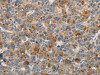 The image on the left is immunohistochemistry of paraffin-embedded Human liver cancer tissue using CSB-PA020742 (DBH Antibody) at dilution 1/70, on the right is treated with fusion protein. (Original magnification: ×200)