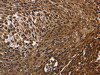 The image on the left is immunohistochemistry of paraffin-embedded Human cervical cancer tissue using CSB-PA244133 (DCP1A Antibody) at dilution 1/50, on the right is treated with fusion protein. (Original magnification: ×200)