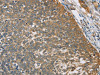 The image on the left is immunohistochemistry of paraffin-embedded Human cervical cancer tissue using CSB-PA057438 (TNFRSF10D Antibody) at dilution 1/40, on the right is treated with fusion protein. (Original magnification: ×200)