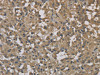 The image on the left is immunohistochemistry of paraffin-embedded Human thyroid cancer tissue using CSB-PA210409 (DCTN3 Antibody) at dilution 1/70, on the right is treated with fusion protein. (Original magnification: ×200)