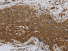 The image on the left is immunohistochemistry of paraffin-embedded Human cervical cancer tissue using CSB-PA210409 (DCTN3 Antibody) at dilution 1/70, on the right is treated with fusion protein. (Original magnification: ×200)